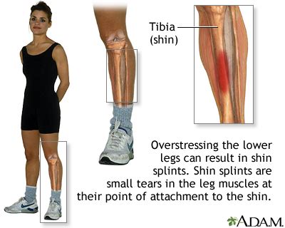 Leg pain Information | Mount Sinai - New York