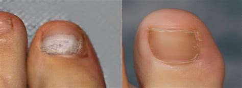 Laser Nail Treatment | Futch Podiatry