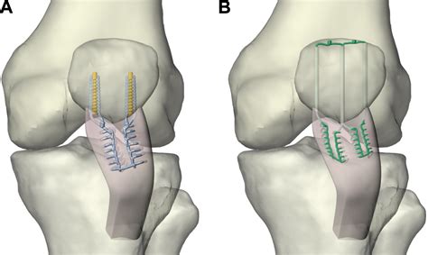 Biomechanical Analysis Of Patellar Tendon Repair With, 55% OFF