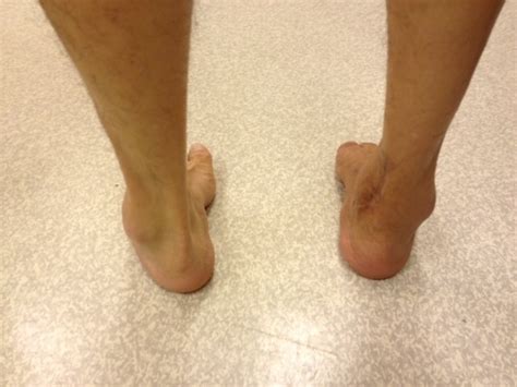 Foot Deformities Singapore|Surgery Reconstruction|Correction