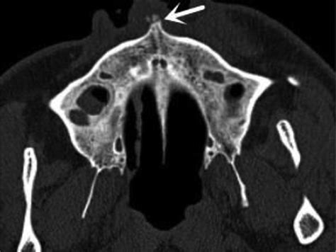 Anterior Nasal Spine Radiograph