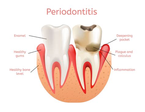 Things you need to know about Periodontal Disease