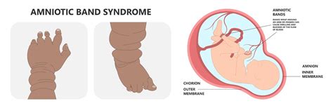 What is Amniotic Band Syndrome?