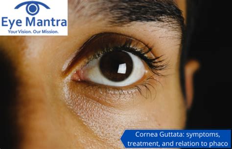 Cornea Guttata: Symptoms And Treatment | How Relate To Phaco