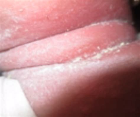 Intertrigo: Pictures, Rash, Symptoms, Causes, Treatment - HubPages