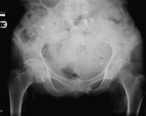 Case 9 e pelvis: OA right hip confused with subcapital fracture ...