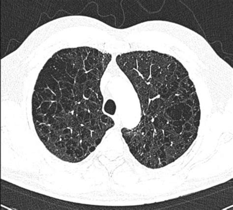 What's the difference between the chest CT for emphysema vs ILD? : r/step1