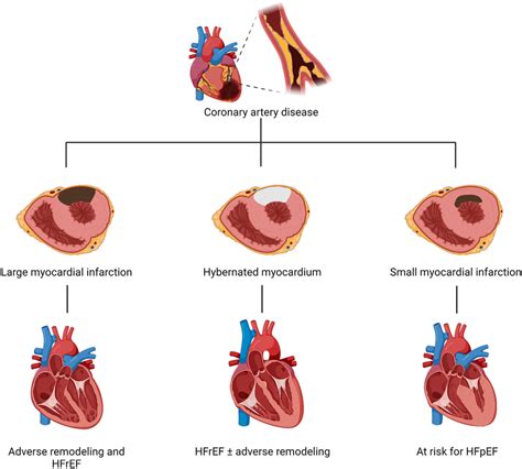 Ischemic Cardiomyopathy: Symptoms Causes, 51% OFF