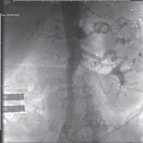 Axial CT scan. Type 1 endoleak compressing the right limb of the ...