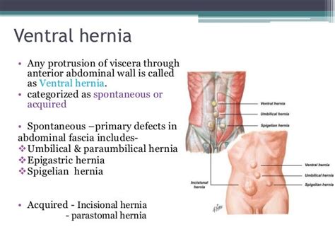 Ventral hernias