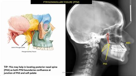 Identifiable anatomical structures in lateral cephalometric radiograph (ceph tracing 1) - YouTube