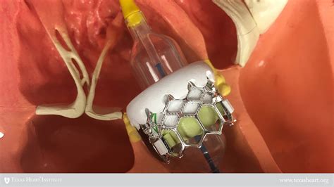 Mechanical Aortic Valve Replacement