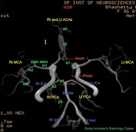 Dr Balaji Anvekar FRCR: Circle of Willis Anatomy