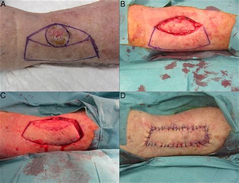 The Keystone Flap in Dermatology: Clinical Experience with 18 Patients ...