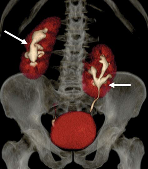 Congenital Anomalies of the Upper Urinary Tract: A Comprehensive Review | RadioGraphics