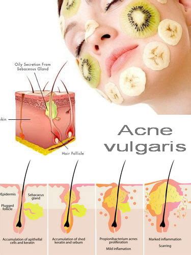 Acne vulgaris | Acne can develop due to various causes such … | Flickr