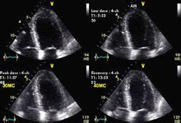 Dobutamine Stress Test - Echocardiogram Test | SA Heart