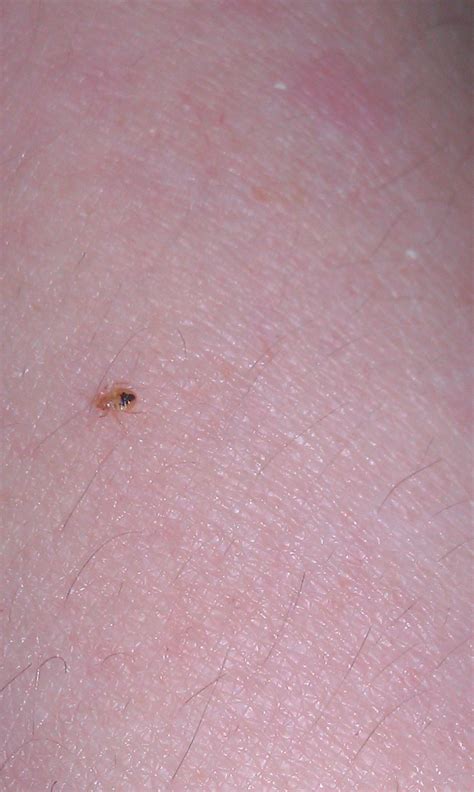 baby bed bugs bites - Annett Mccauley