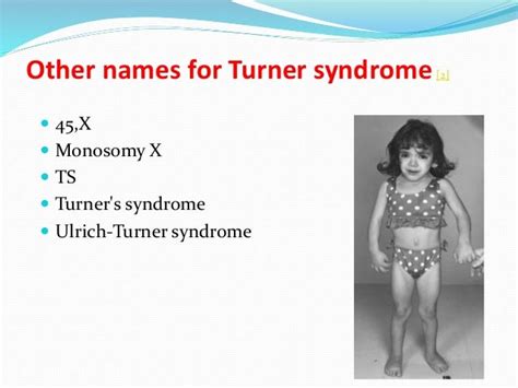Turner syndrome