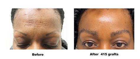 Eyebrow - iHair.com - Robotic Hair Restoration