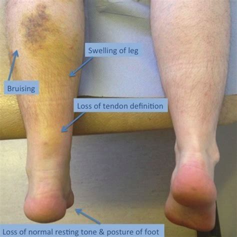 Achilles Tendon Rupture – Core EM