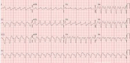 Sustained ventricular tachycardias - Symptoms, diagnosis and treatment | BMJ Best Practice