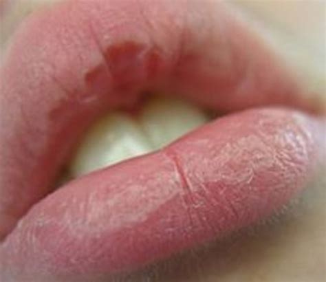 11 Natural Ways to Cure Chapped, Cracked, and Peeling Lips - RemedyGrove