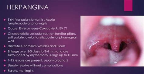 Herpangina - Toddlers, Adults, What is, Pictures, Rash, Symptoms, Virus