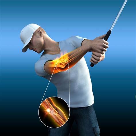 Golfer’s Elbow– 7 Best Golfer's Elbow Pain Relief Treatments