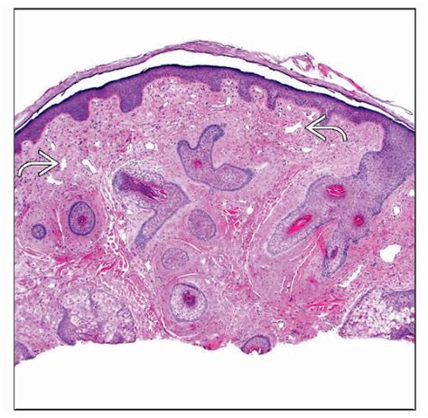 Nasopharyngeal Angiofibroma Histology