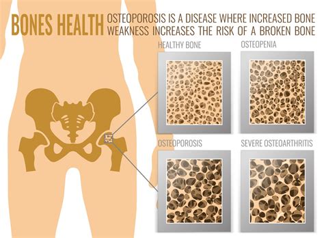 I Have Osteoporosis, What Are My Treatment Options?