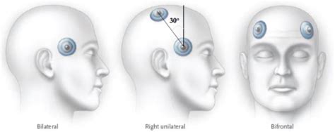 Electroconvulsive Therapy (ECT) - PsychDB