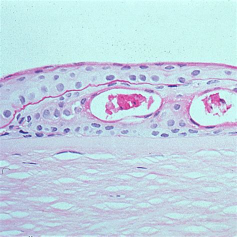 Figure 63:Corneal dystrophies- Open-i