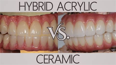 What's the difference between acrylic and ceramic? | Patients Ask - YouTube