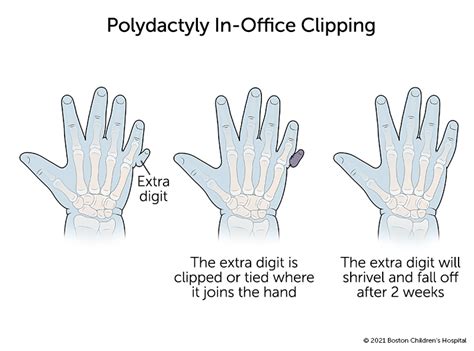 Polydactyly | Boston Children's Hospital