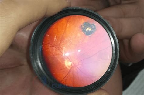 Indirect Ophthalmoscopy: Everything You Need To Know