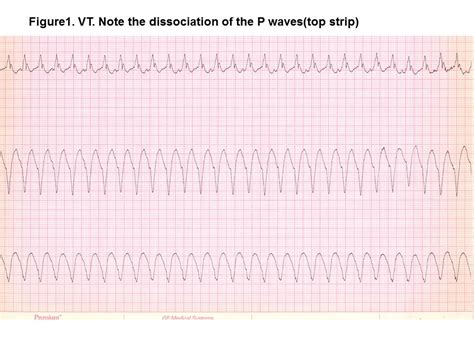 Treatment of Ventricular Arrhythmias - The Cardiology Advisor