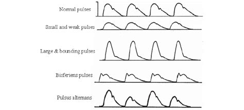 Dicrotic Notch And Aortic Stenosis