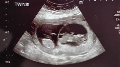 Twin Ultrasound 12 Weeks: Dating & Chorionicity Scan – About Twins