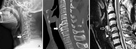 Cervical Osteophytes