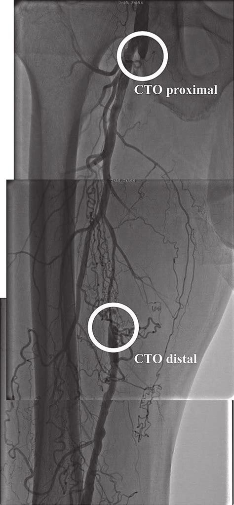 Angiography of right superficial femoral artery (SFA). Angiography... | Download Scientific Diagram