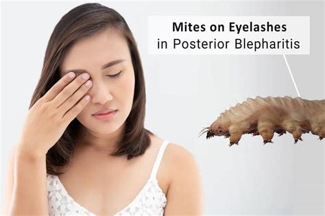 Demodex Mites on Eyelashes in Posterior Blepharitis in 2021 | Eye mites, Demodex, Blepharitis