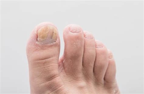 Is Athlete’s Foot Related to Toenail Fungus?