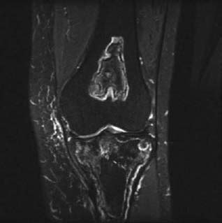 78 Medullary Bone Infarct | Radiology Key