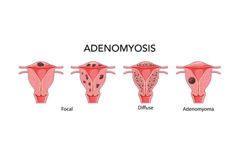 What is Adenomyosis?