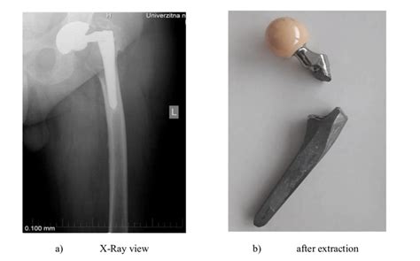 Prematurely failed endoprosthesis | Download Scientific Diagram