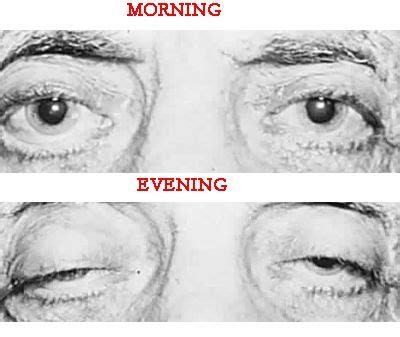 A GP may also suspect Myasthenia Gravis if the patient has impaired eye movements or muscle ...