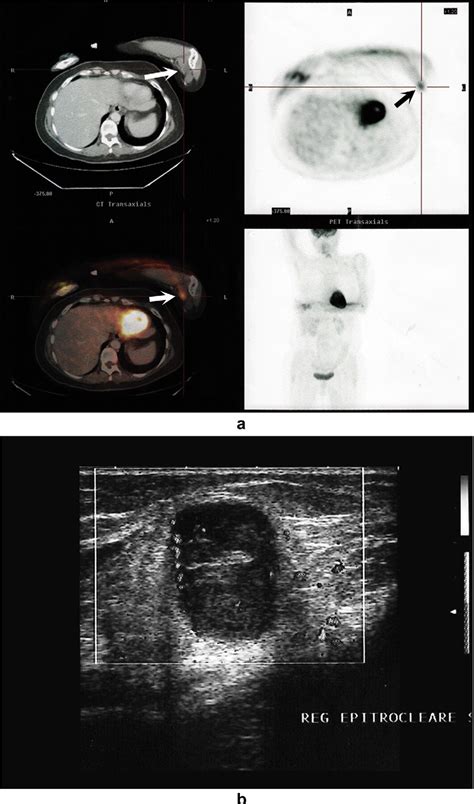 Structure of epitrochlear lymph node | Semantic Scholar