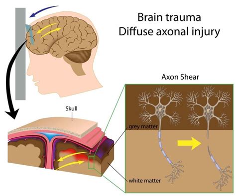 Learn About The Different Types Of Brain Injury With Premier Neurology