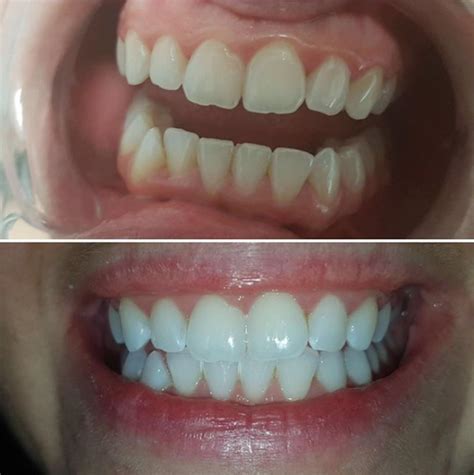 Snow Teeth Whitening Reviews (Before/After Photos)